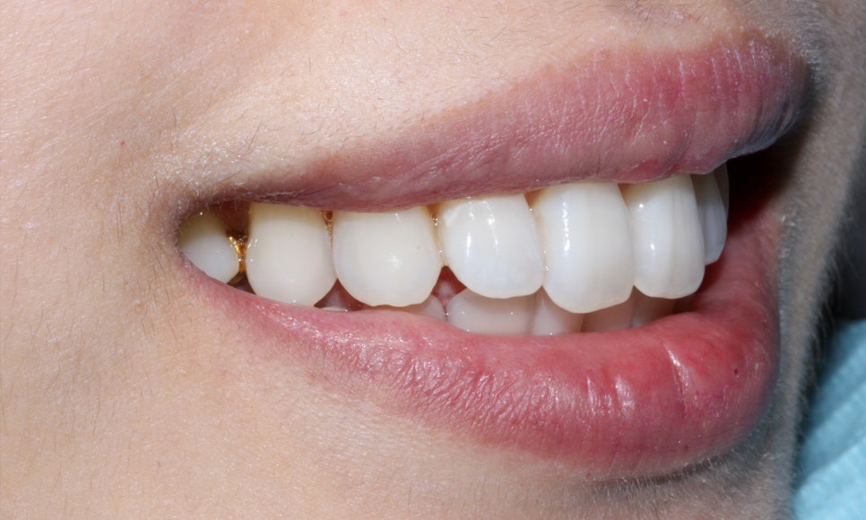 토끼 이빨 치아교정 5개월 교정 완료! by. 투디치과(2D치과) 관련 이미지 2