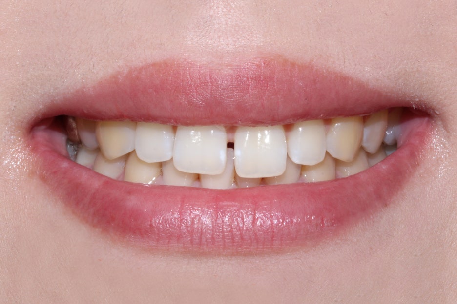 벌어진앞니 치간이개 공간 삭제하기! 관련 이미지 1