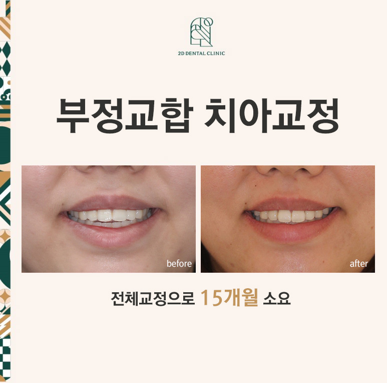 부정교합 치아교정, 전체교정으로 완성하기! by. 투디치과(2D치과) 관련 이미지 1