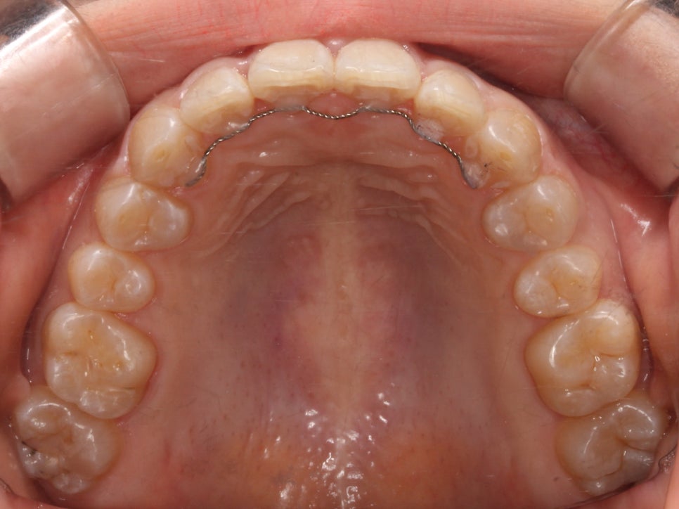나비치아교정, 부분 치아교정으로 하고 싶다면? by.투디치과(2D치과) 관련 이미지 14