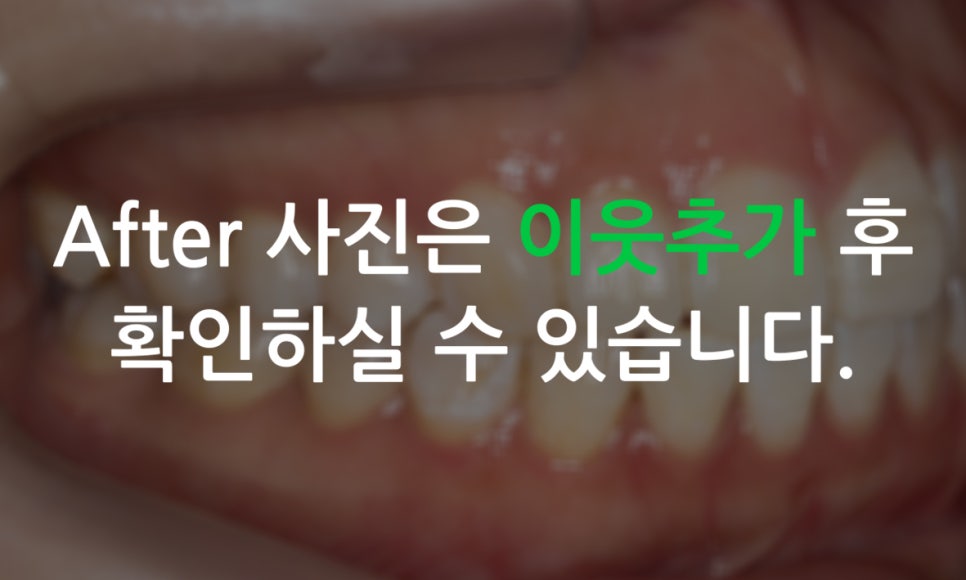 앞니돌출 급속교정 Case feat. 2D교정 관련 이미지 12