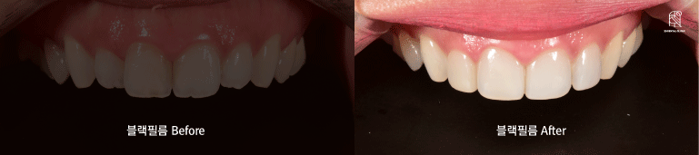 무삭제라미네이트는 어느 병원에서 해야할까요? 관련 이미지 5