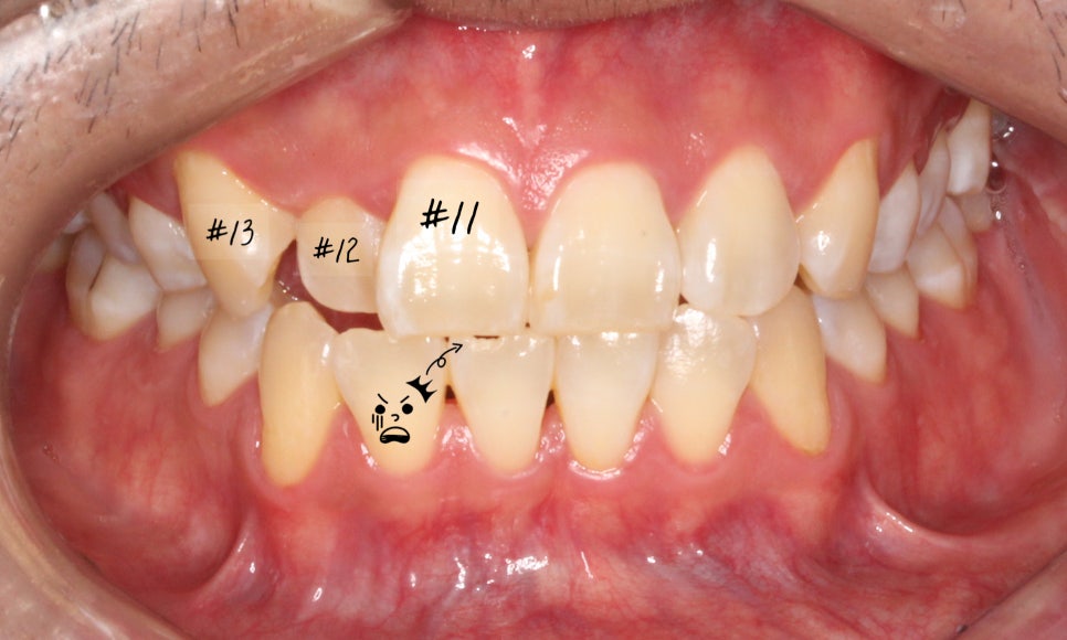 앞니 덧니 고민, 부분 설측 교정으로 해결한 사례 관련 이미지 2