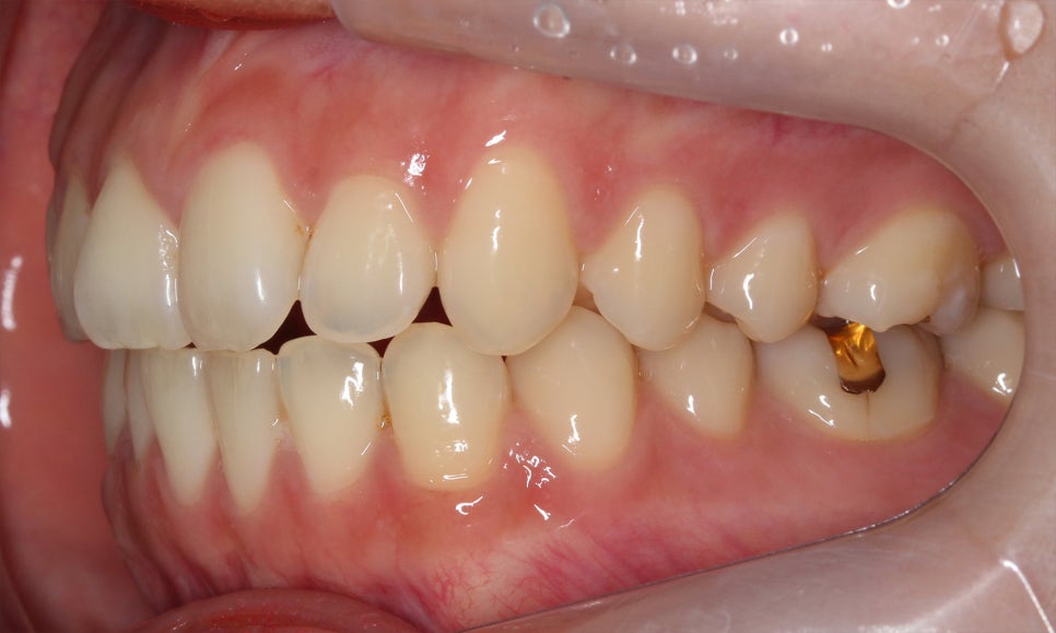 나비앞니 세라믹교정 case 관련 이미지 5