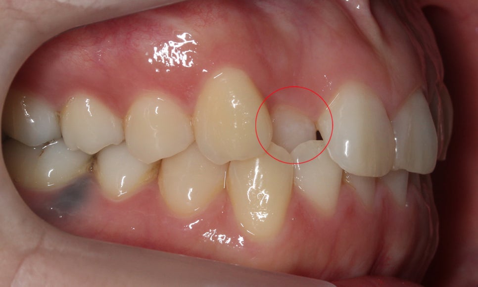 덧니교정 2D교정 (부분교정) 후기 관련 이미지 3
