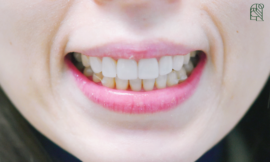 벌어진 앞니, 앞니벌어짐(diastema) 치료 - 레진, 교정, 라미네이트 관련 이미지 5