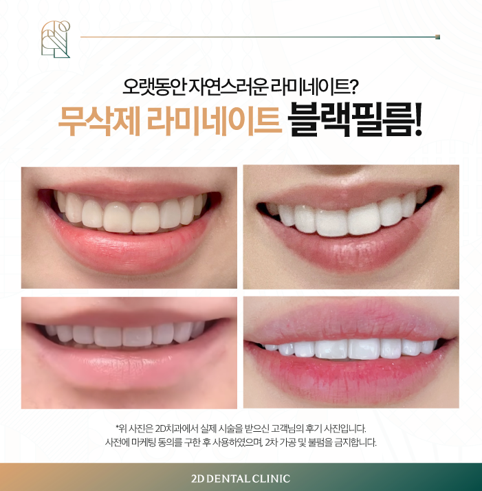 무삭제라미네이트부작용 치과라미네이트, A/S는? 관련 이미지 8