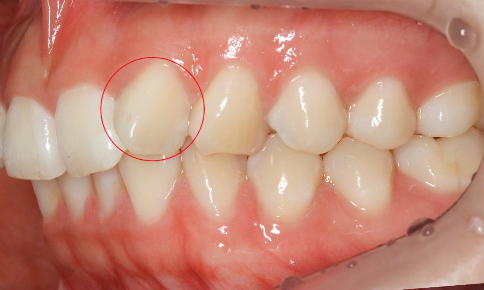 세라믹교정 앞니틀어짐 교정 사례 관련 이미지 6