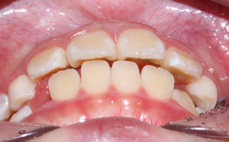 어린이 반대교합 덧니 교정으로 교정 끝! by. 투디치과(2D치과) 관련 이미지 15