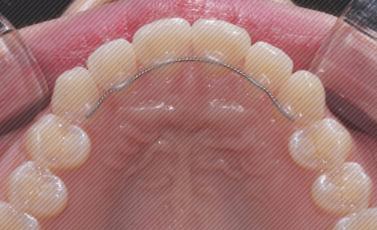 [신논현역치과] 앞니돌출 2D교정으로 개선! 관련 이미지 8