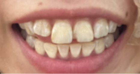 부분 라미네이트 치아 심미치료는 무삭제로 진행가능한 블랙필름 관련 이미지 3