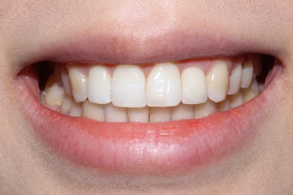 왜소치 뻐드렁니 교정 신논현역치과에서 관련 이미지 9