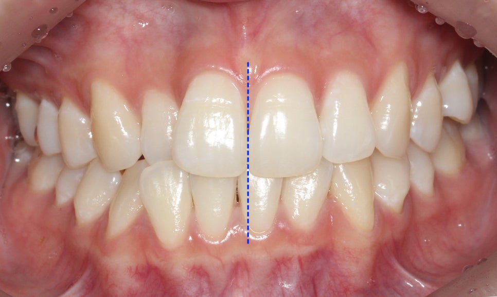 신논현치과 자가결찰브라켓 장점 관련 이미지 1