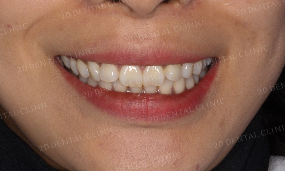 [부분교정] 틀어진 앞니, 부분교정으로 앞니교정하기! by.투디치과(2D치과) 관련 이미지 3