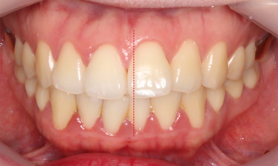 입툭튀 교정 신논현역치과 전체교정으로 관련 이미지 1