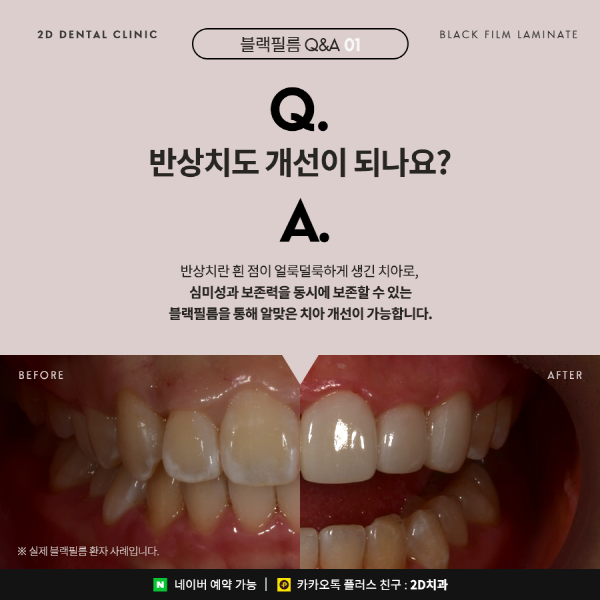 무삭제 라미네이트 <블랙필름> 이 궁금하다면? 관련 이미지 3