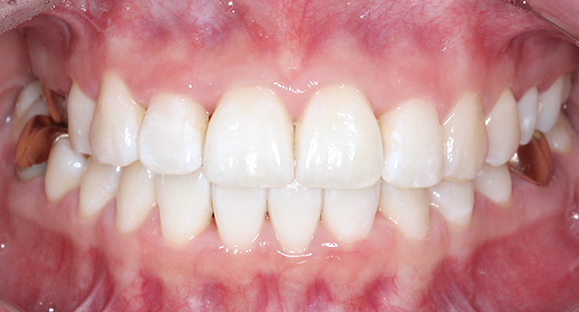 2D치과 2D교정으로 4개월만에 덧니 개선! 관련 이미지 13