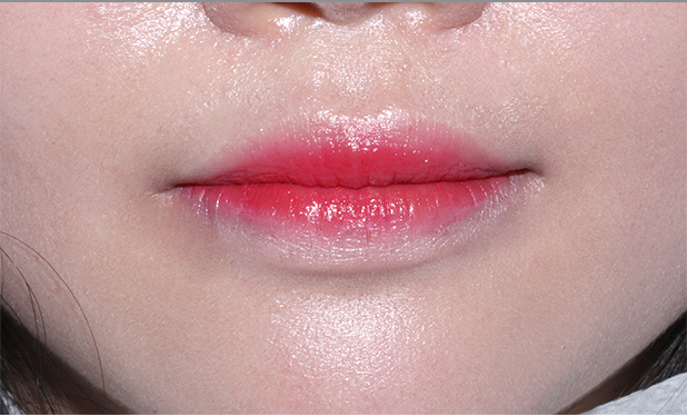 덧니치아 2D교정으로 4개월만에 교정 끝! by.투디치과(2D치과) 관련 이미지 9