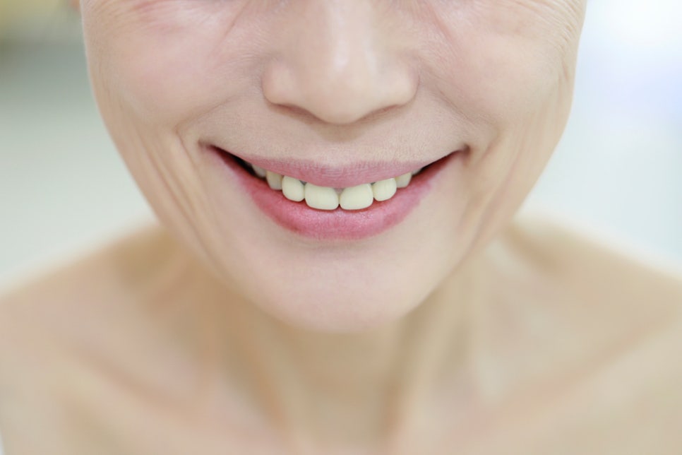 라미네이트치아삭제, 걱정되어 망설이고 계신가요? 관련 이미지 2