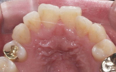 결혼식 6개월 남기고 급속교정으로 토끼이빨 탈출! 관련 이미지 4