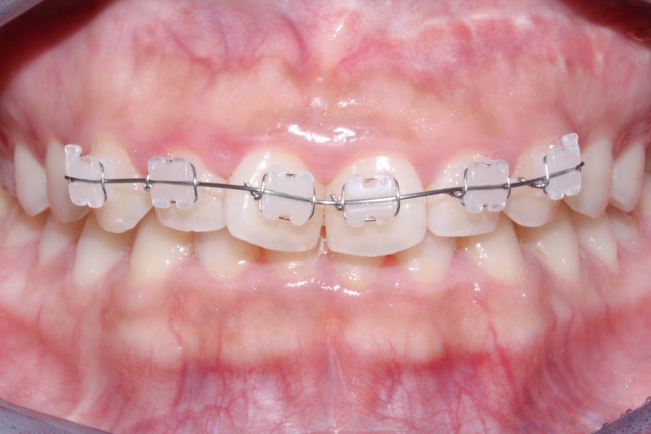 옥니교정 방법! 세라믹교정 Case 관련 이미지 5