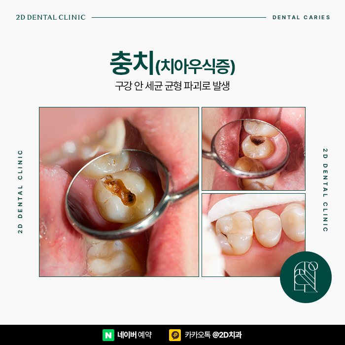 충치통증? 2D치과의 충치치료로 역삼동치과 관련 이미지 2