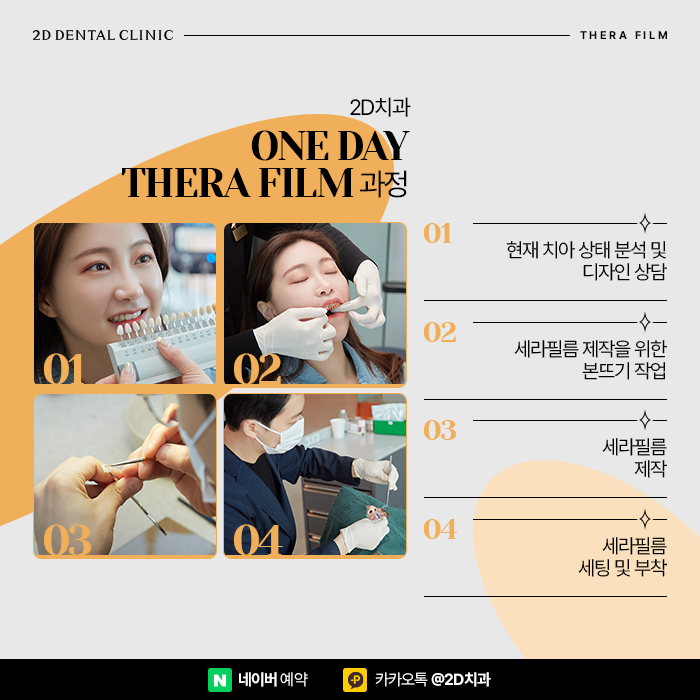 강남 연예인치아성형 환한 미소 부럽다면 원데이 세라필름 관련 이미지 3