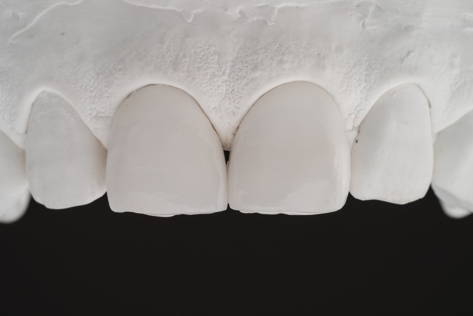 깨진 치아, 벌어진 치아 전부 관련 이미지 6