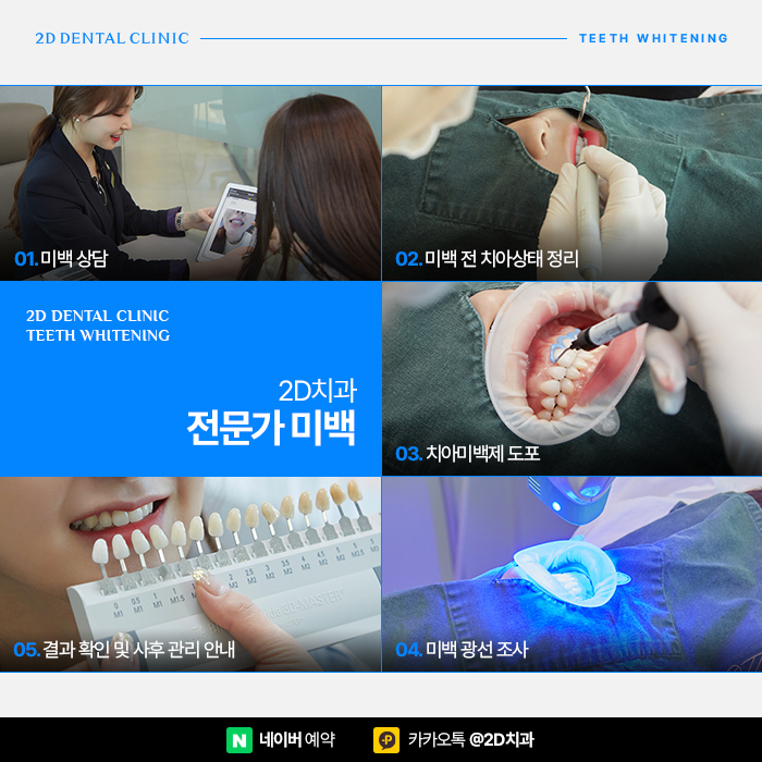 치아미백 가격, 비용 걱정 없이 진행하려면, 신논현 치아미백 치과 관련 이미지 6