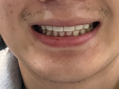 무삭제라미네이트 블랙필름 케이스 비포 에프터 후기 관련 이미지 13