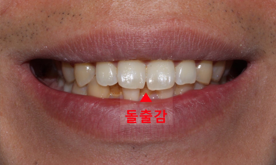 뻐드렁니 교정, 강남역치과에서 앞니 부분 교정한 후기! 관련 이미지 3