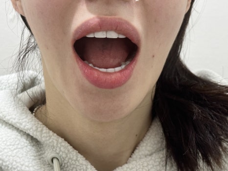 무삭제라미네이트 블랙필름 케이스 비포 에프터 후기 관련 이미지 4