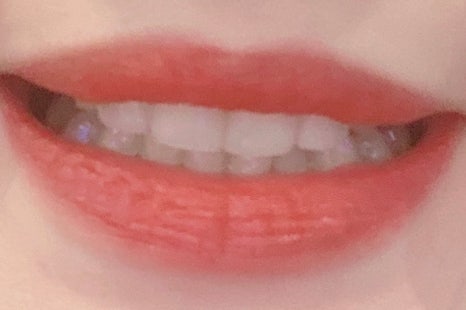 무삭제라미네이트후기 많은 고객님들의 찐후기가 많은 2D치과 관련 이미지 3