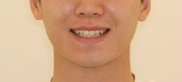 부분교정으로 삐뚤어진 앞니 예뻐지는 방법 관련 이미지 21