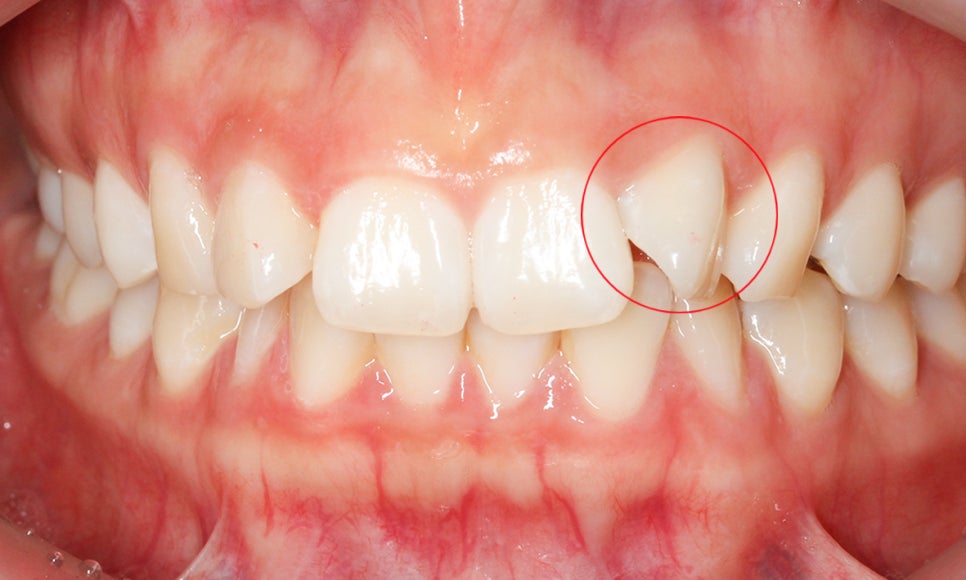 세라믹교정 앞니틀어짐 교정 사례 관련 이미지 1