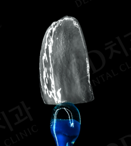 앞니충치 무삭제라미네이트비용 블랙필름 관련 이미지 9