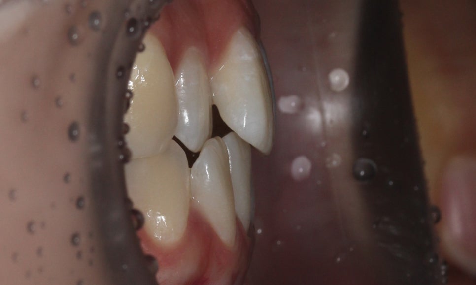 신논현치과 자가결찰브라켓 장점 관련 이미지 4