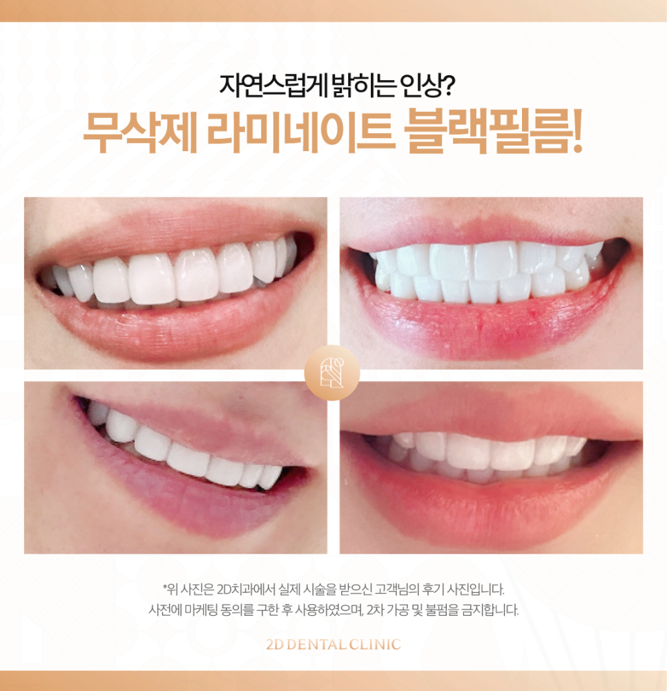 광주무삭제라미네이트 치아미백효과 자연스러움을 찾는 분들 주목 관련 이미지 6