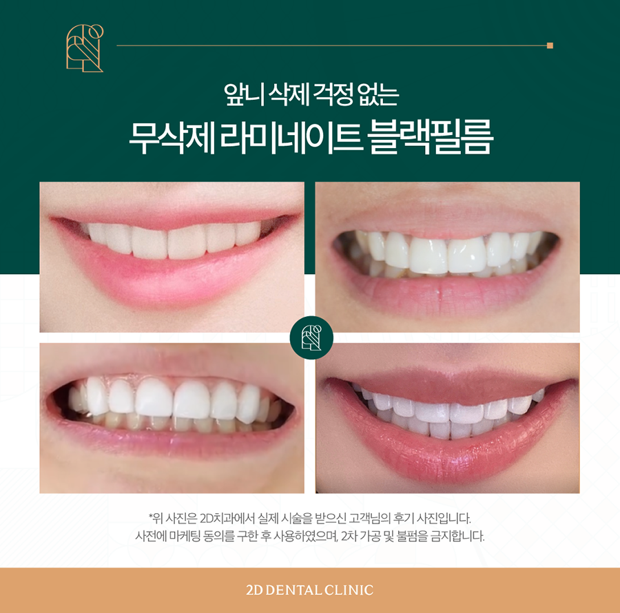 전주무삭제라미네이트 앞니 고민 개선은 블랙필름으로 관련 이미지 7