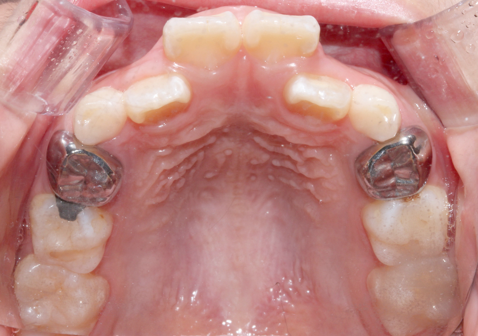 (2D)투디치과: 성장기 어린이 비발치 부정교합 후기 과정. 관련 이미지 5