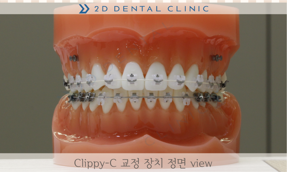 [교정상식] 치아교정, 그것이 알고싶다! 관련 이미지 4