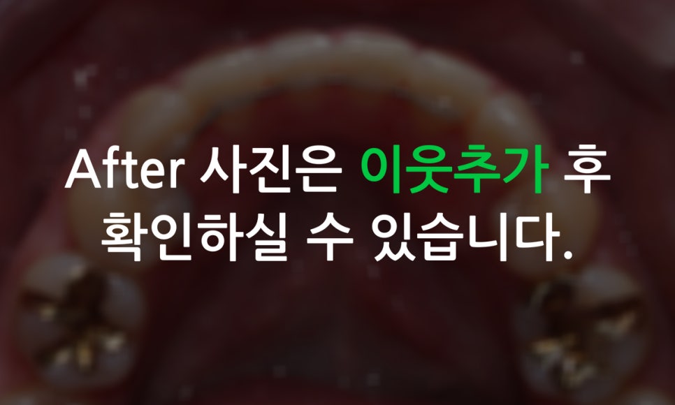 송곳니덧니 교정하는 방법! 관련 이미지 7
