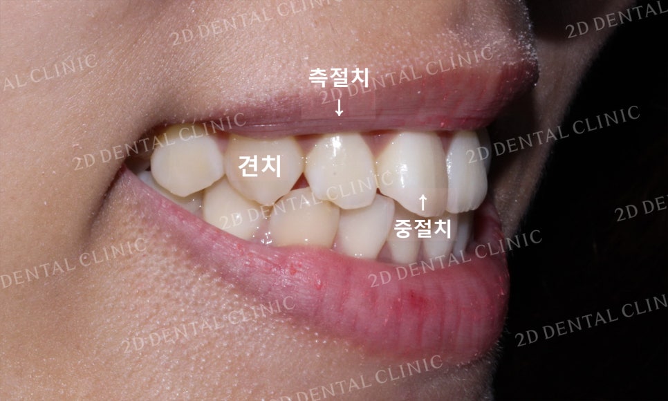 토끼앞니, 튀어나온 앞니 부분교정 후기! by.투디치과(2D치과) 관련 이미지 10