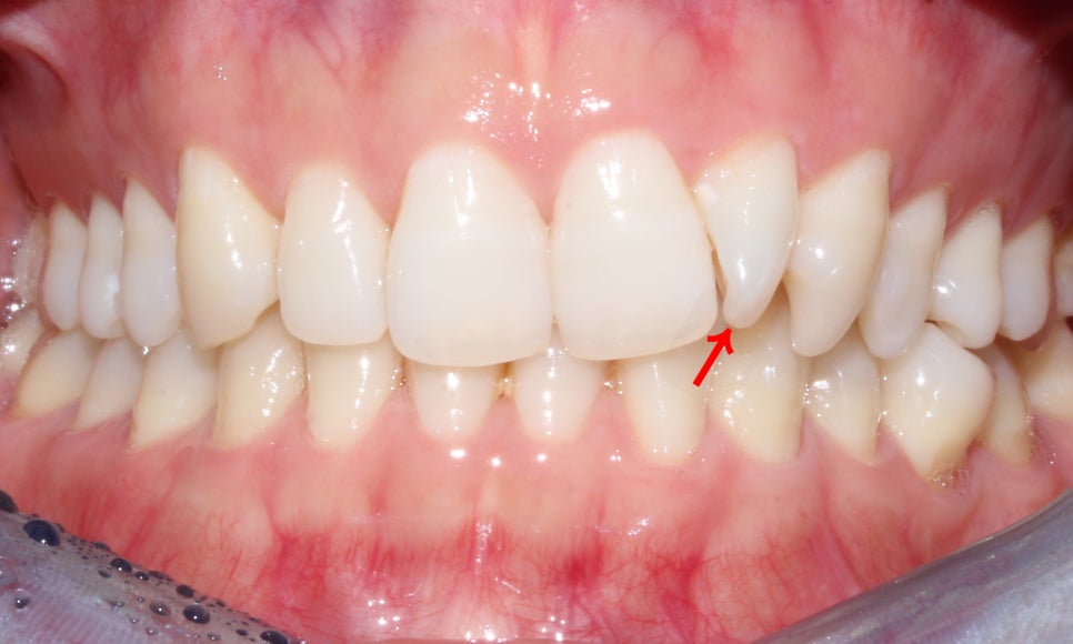앞니틀어짐 2D교정으로 한번에 끝내는 방법! 관련 이미지 4