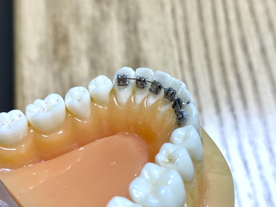 부분교정으로 삐뚤어진 앞니 예뻐지는 방법 관련 이미지 3