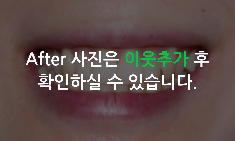 앞니틀어짐 2D교정으로 한번에 끝내는 방법! 관련 이미지 10