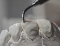 라미네이트 치료 전 체크해야할 부분은? 관련 이미지 7