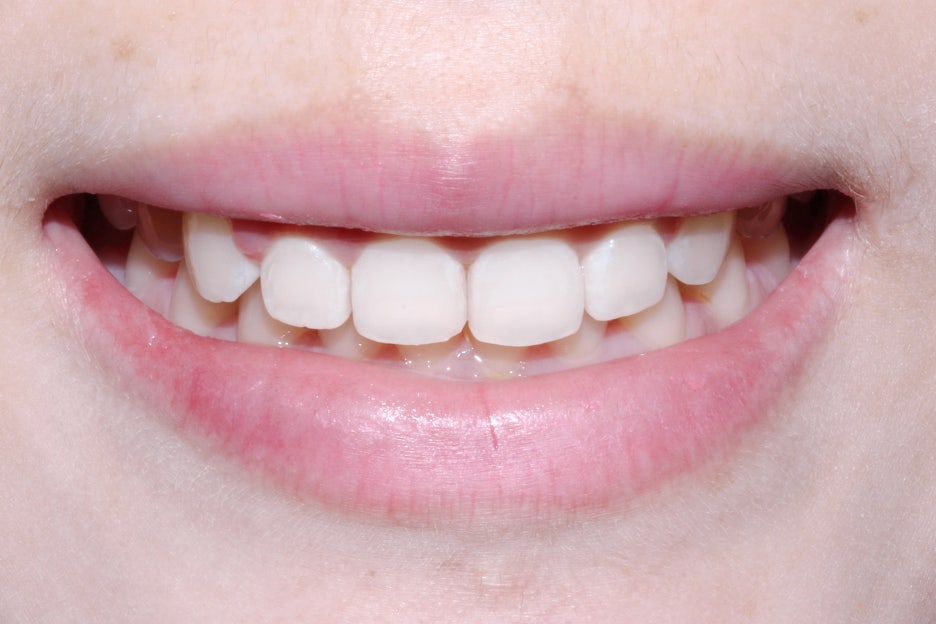 옥니교정 방법! 세라믹교정 Case 관련 이미지 9