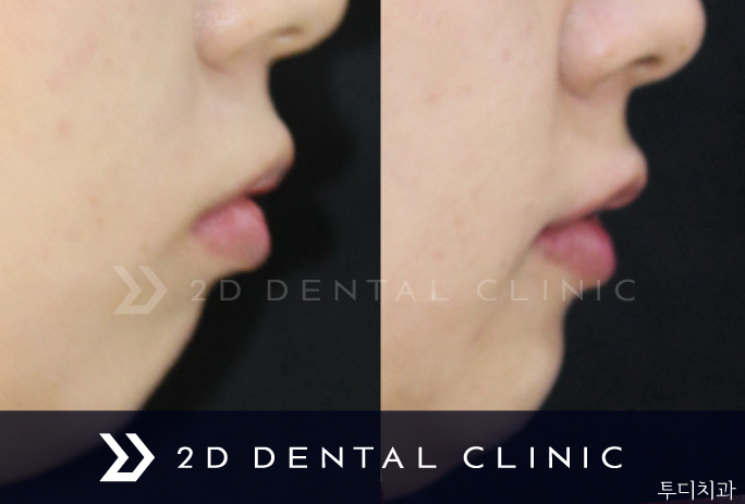 콤비교정, 합리적인 비용으로 돌출입 개선하자! 강남 투디치과 관련 이미지 6