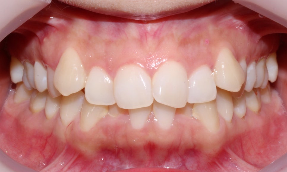 돌출입 탈출기! 덧니 교정도 문제없어! by.투디치과(2D치과) 관련 이미지 2